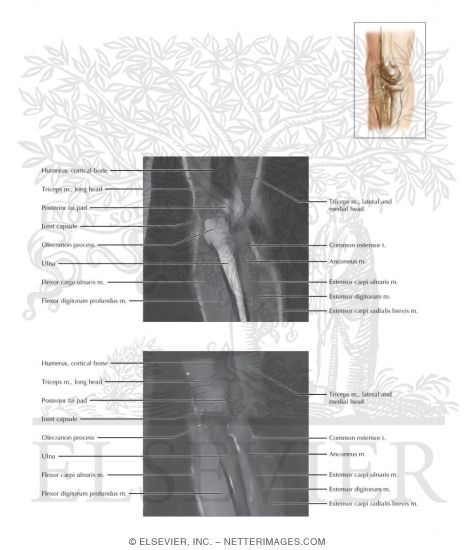 Watermarked preview of labeled image: Cross Section of the Elbow: Coronal View