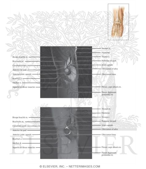 Watermarked preview of labeled image: Cross Section of the Elbow: Sagittal View