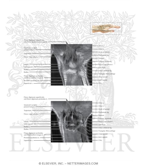 Watermarked preview of labeled image: Cross Section of the Wrist: Coronal View