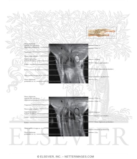 Watermarked preview of labeled image: Cross Section of the Wrist: Coronal View