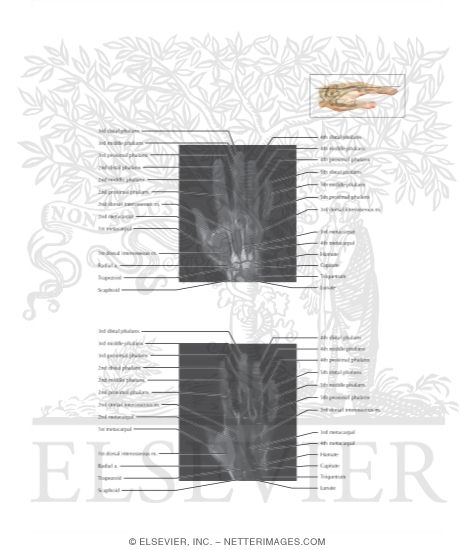 Watermarked preview of labeled image: Cross Section of the Hand and Finger: Coronal View