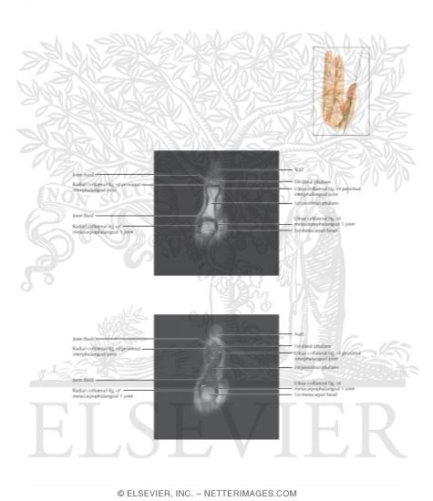 Watermarked preview of labeled image: Cross Section of the Thumb: Coronal View