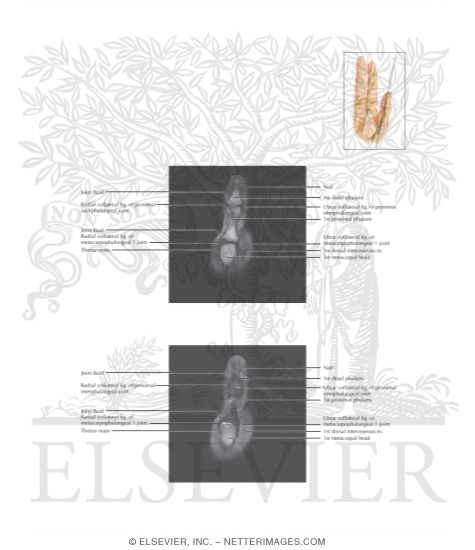 Watermarked preview of labeled image: Cross Section of the Thumb: Coronal View