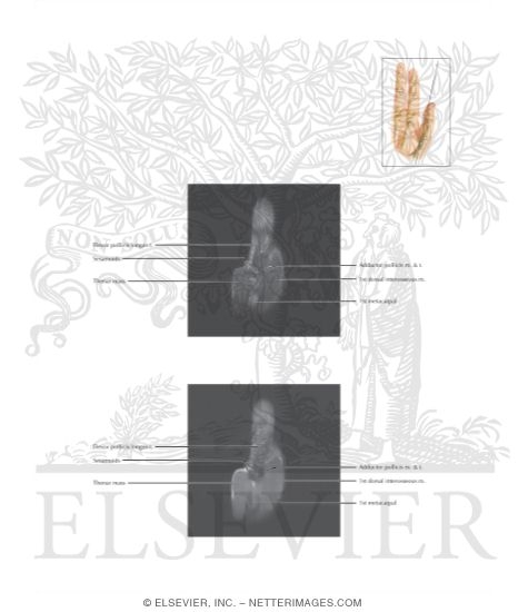 Watermarked preview of labeled image: Cross Section of the Thumb: Coronal View