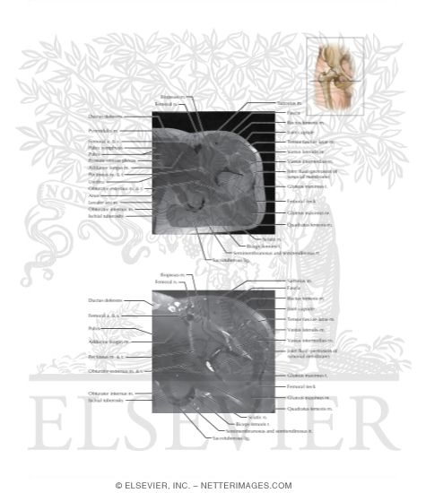 Watermarked preview of labeled image: Cross Section of the Hip: Axial View