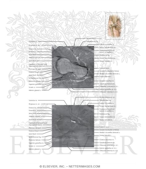 Watermarked preview of labeled image: Cross Section of the Hip: Axial Oblique View