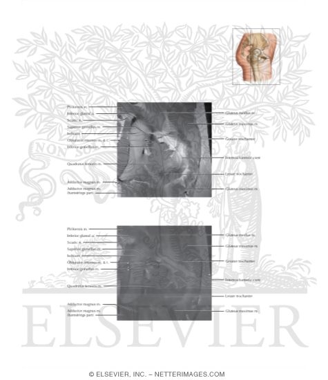Watermarked preview of labeled image: Cross Section of the Hip: Coronal View