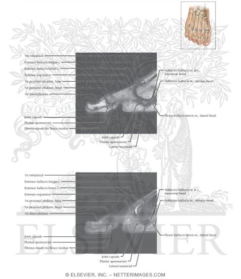 Watermarked preview of labeled image: Cross Section of the Plantar Plate: Sagittal View