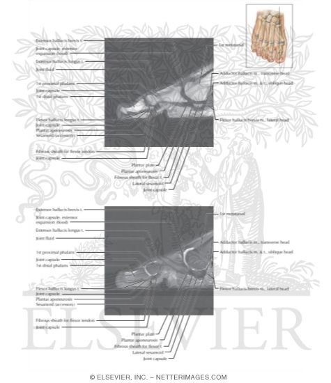 Watermarked preview of labeled image: Cross Section of the Plantar Plate: Sagittal View
