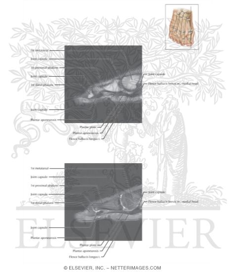 Watermarked preview of labeled image: Cross Section of the Plantar Plate: Sagittal View