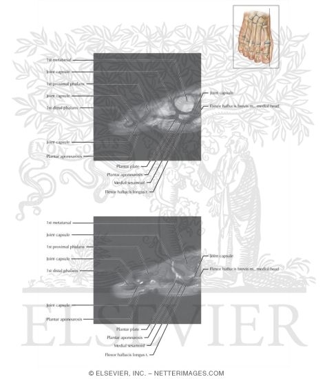 Watermarked preview of labeled image: Cross Section of the Plantar Plate: Sagittal View