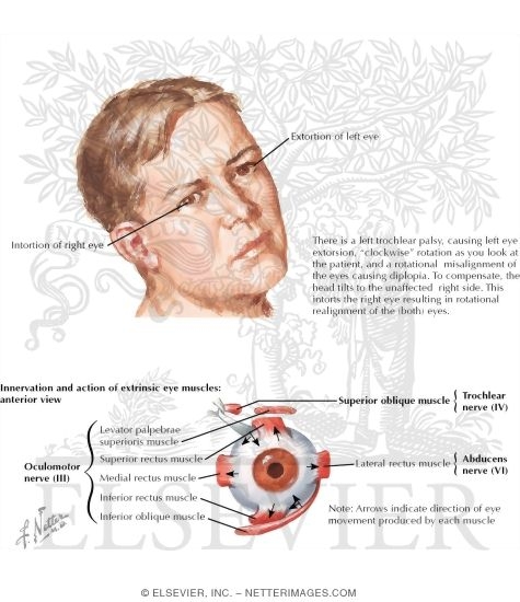 Trochlear Nerve (CN-IV)