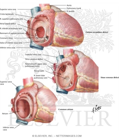 Watermarked preview of labeled image: Atrial Septal Defects