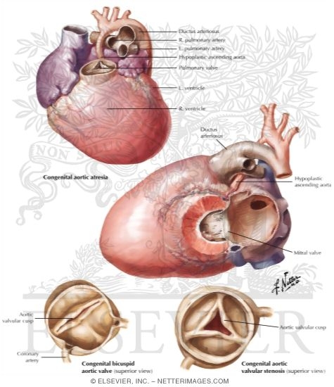 Anomalies of the Left Ventricular - Outflow Tract
Congenital Aortic Stenosis