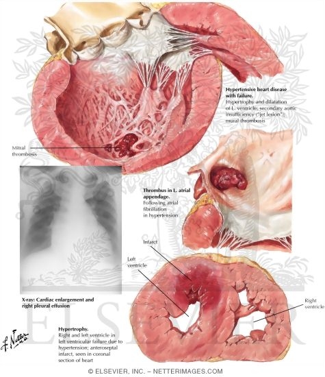 Watermarked preview of labeled image: Heart Disease in Hypertension
Hypertension and Cardiomyopathy