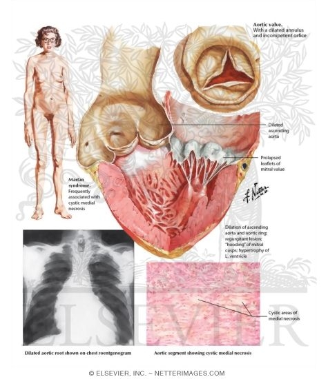 Cystic Medial Necrosis of the Aorta