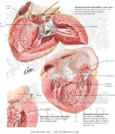 Bacterial Endocarditis - Advanced Lesions