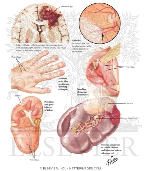 Watermarked preview of labeled image: Bacterial Endocarditis - Remote Embolic Effects