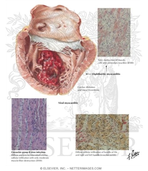 Diphtheritic and Viral Myocarditis