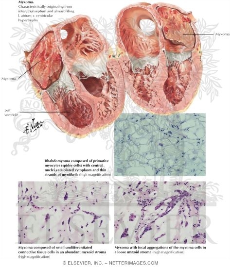 Heart Tumors