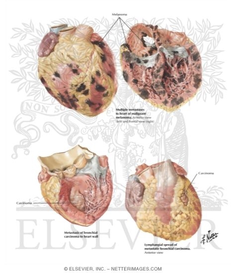 Watermarked preview of labeled image: Metastatic Heart Tumors