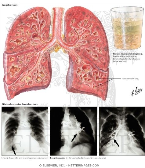 Bronchiectasis