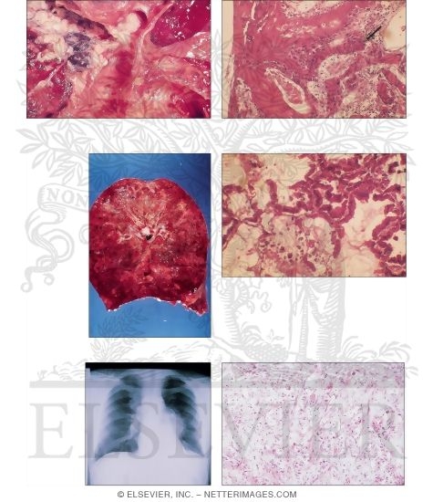 Watermarked preview of unlabeled image: Non-Small-Cell Lung Cancer