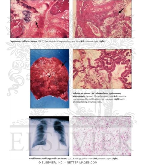 Watermarked preview of labeled image: Non-Small-Cell Lung Cancer