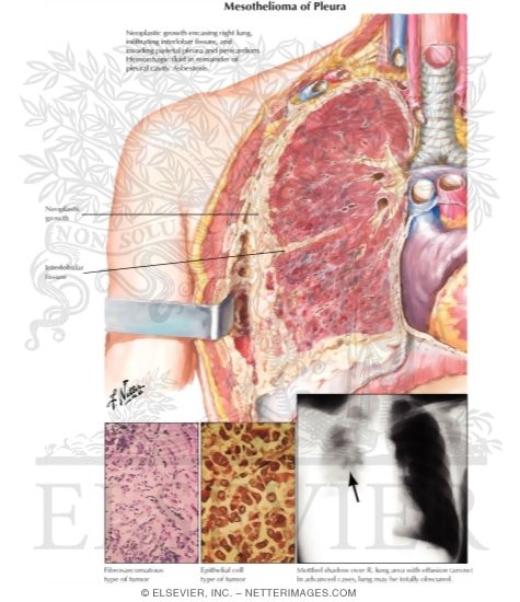 Watermarked preview of labeled image: Mesothelioma of Pleura