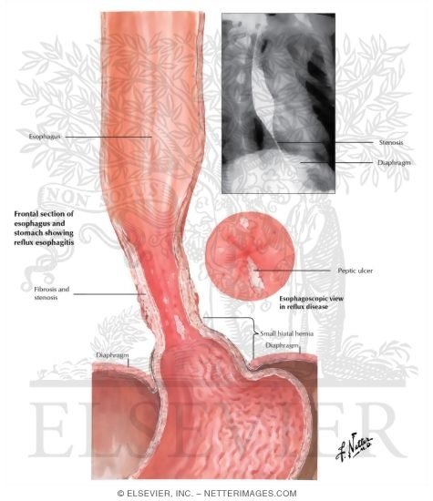 Esophagitis, Esophageal Ulcers - Peptic Esophagitis