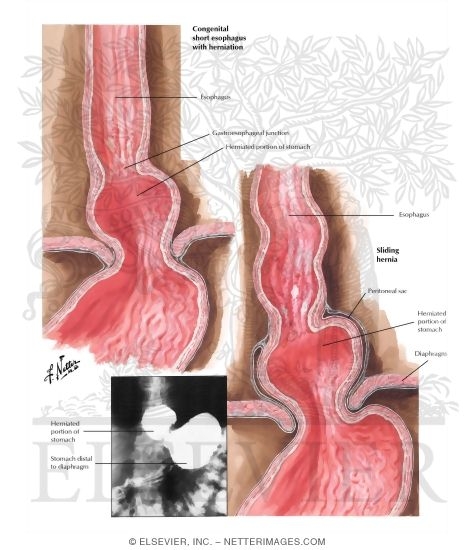 Watermarked preview of labeled image: Thoracic Stomach I - Short Esophagus, Sliding Hernia