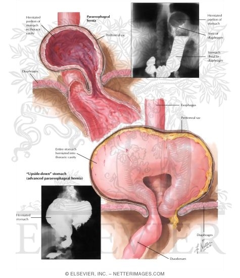 Watermarked preview of labeled image: Thoracic Stomach II - Paracardial Hernia