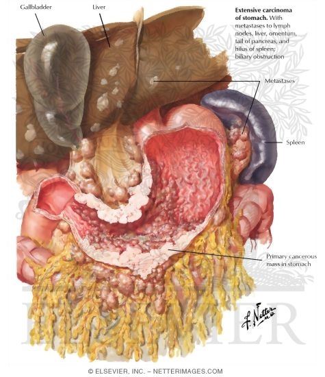 Watermarked preview of labeled image: Spread of Carcinoma of Stomach
