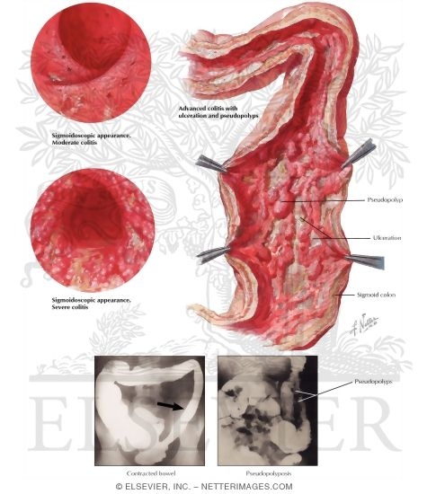 Watermarked preview of labeled image: Ulcerative Colitis