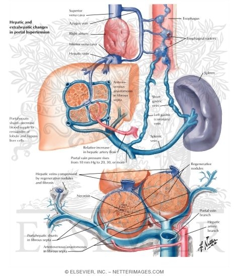 Watermarked preview of labeled image: Cirrhosis II - Fundamental Vascular Changes