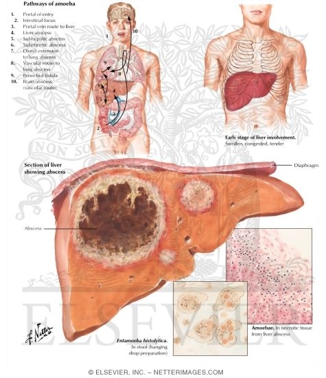 Amebiasis