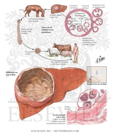 Echinococcus Cyst (Hydatid Disease)