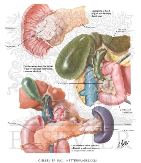 Watermarked preview of labeled image: Malignant Tumors II - Carcinoma, Gross Pathology and Clinical Features