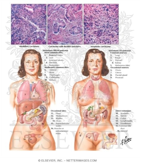 Watermarked preview of labeled image: Malignant Tumors III - Histology, Metastases