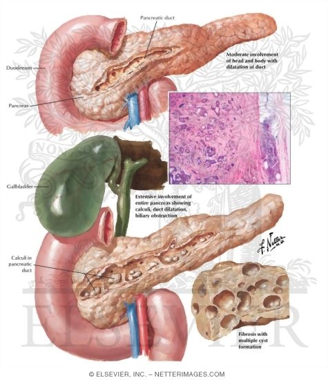Chronic pancreatitis life expectancy image