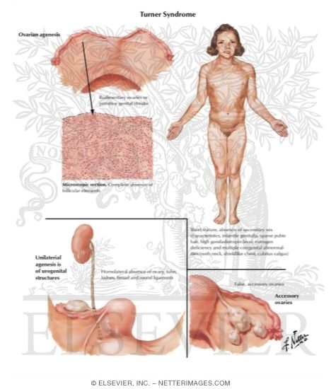 Watermarked preview of labeled image: Turner's Syndrome