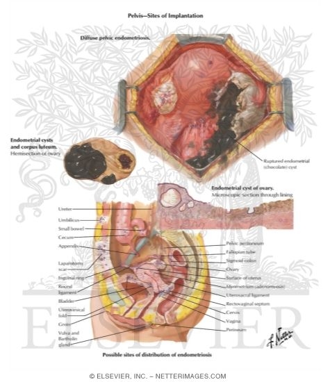 Watermarked preview of labeled image: Endometriosis II - Pelvis