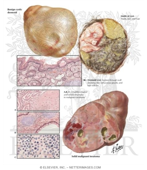 Teratoma, Dermoid Cyst, Solid Teratoma