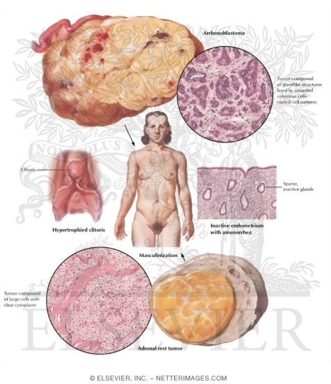 Masculinizing Neoplasms, Arrhenoblastoma, Adrenal Rest Tumor