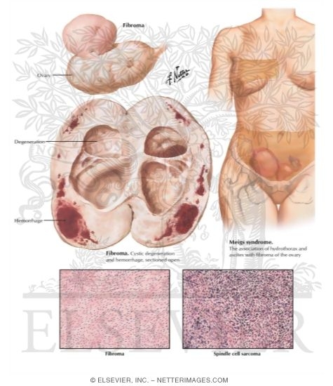 Watermarked preview of labeled image: Placenta Previa