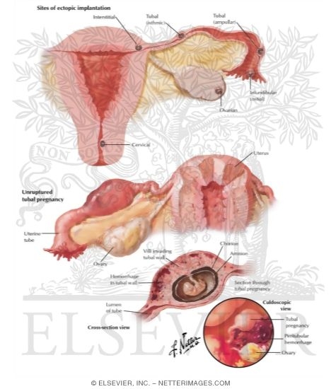 Watermarked preview of labeled image: Ectopic Pregnancy