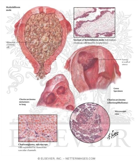 Watermarked preview of labeled image: Gestational Trophoblastic Disease