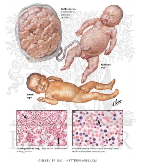 Erythroblastosis Fetalis