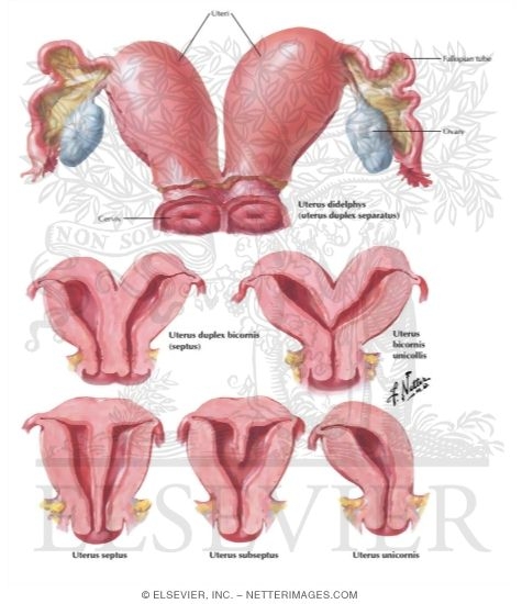 Uterine Anomalies: Bicornuate, Septate, and Unicornuate Uterus