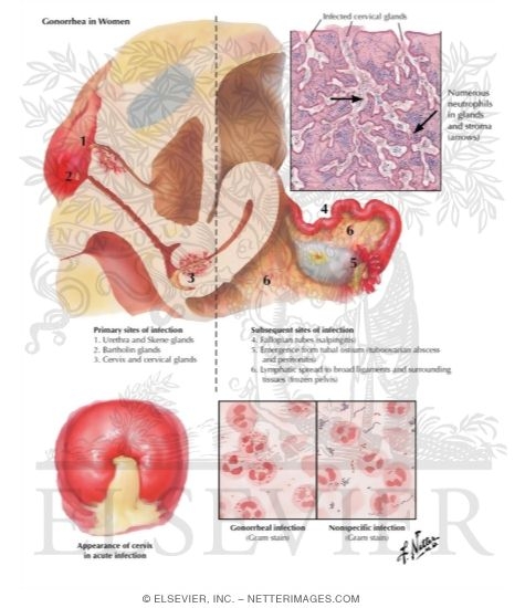 Watermarked preview of labeled image: Cervicitis II - Gonorrhea, Pyogenic Infections